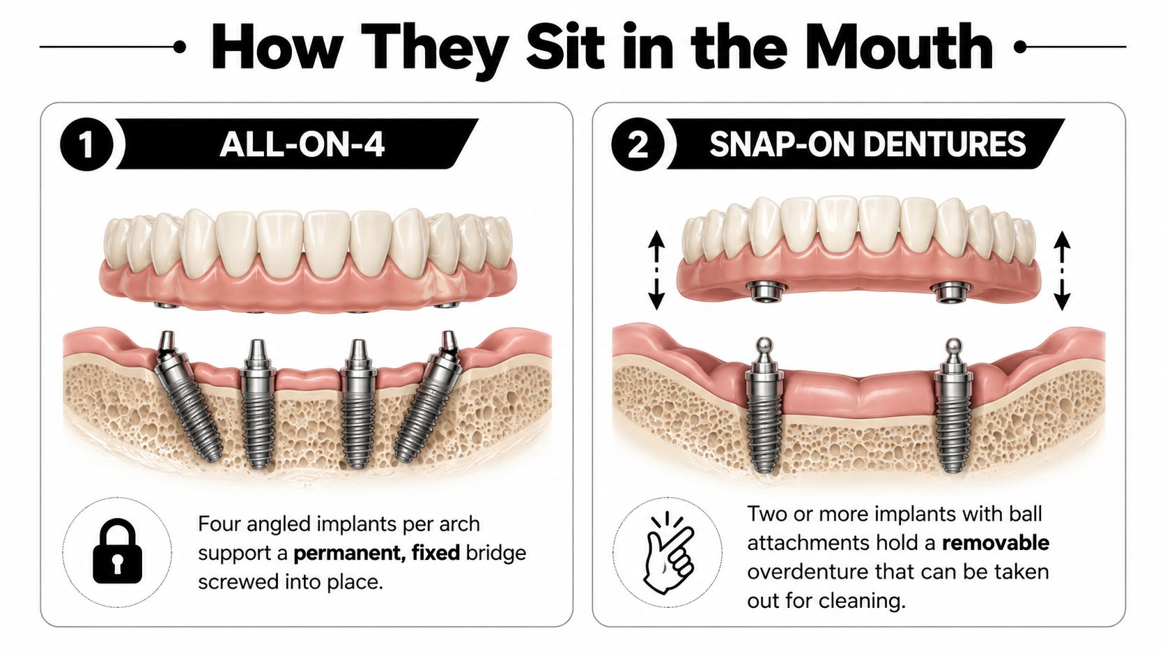 A diagram comparing All-on-4 permanent dental implants with removable snap-on dentures for tooth replacement solutions.