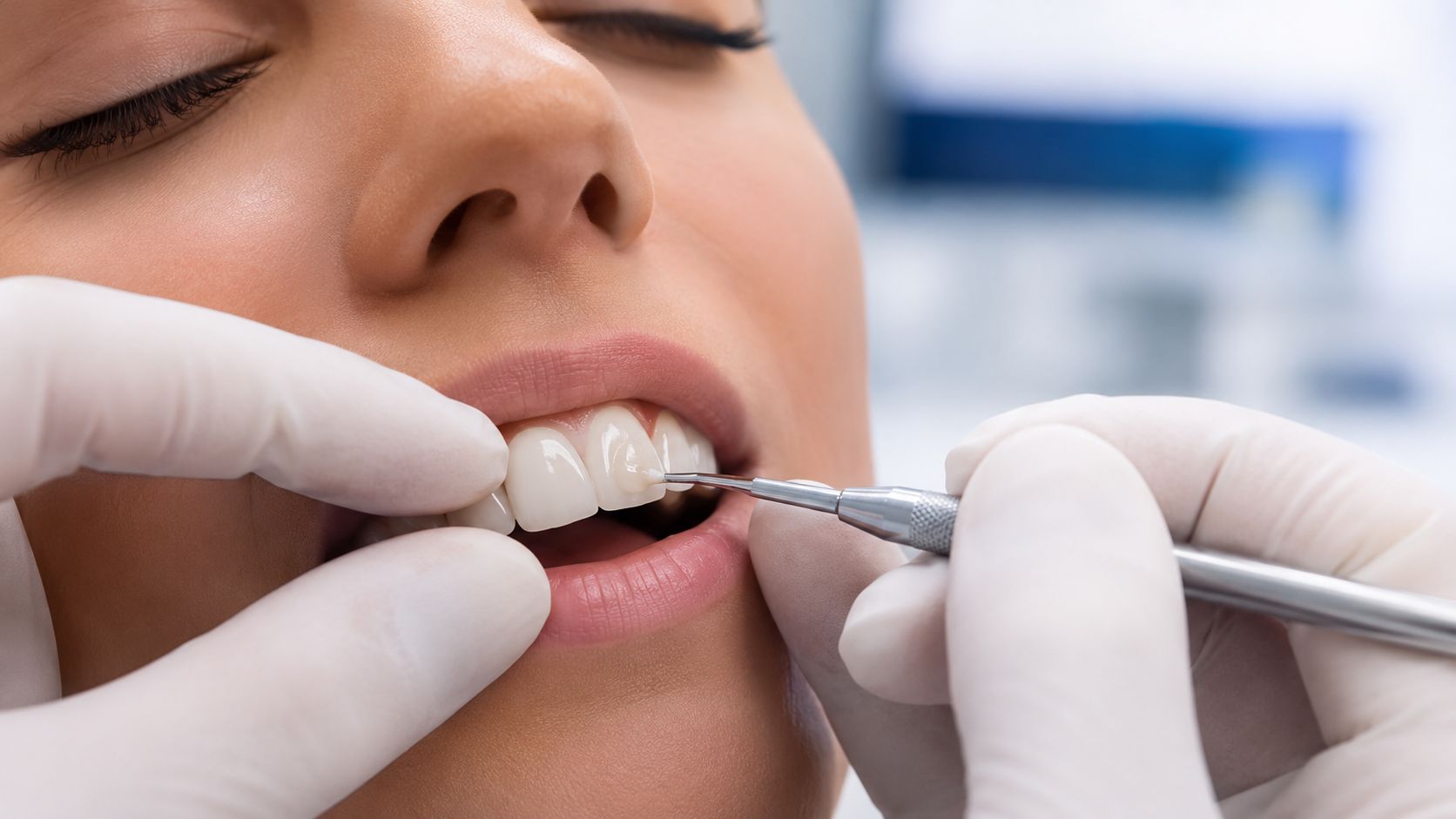 A dentist wearing white gloves performs a dental bonding procedure on a patient's front tooth.