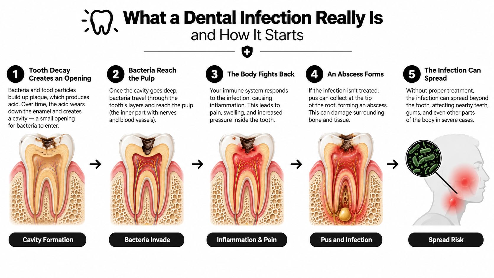 An infographic showing the five-step progression of a dental infection from cavity formation to systemic spread.