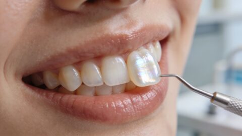 Dental Veneer Implant Service