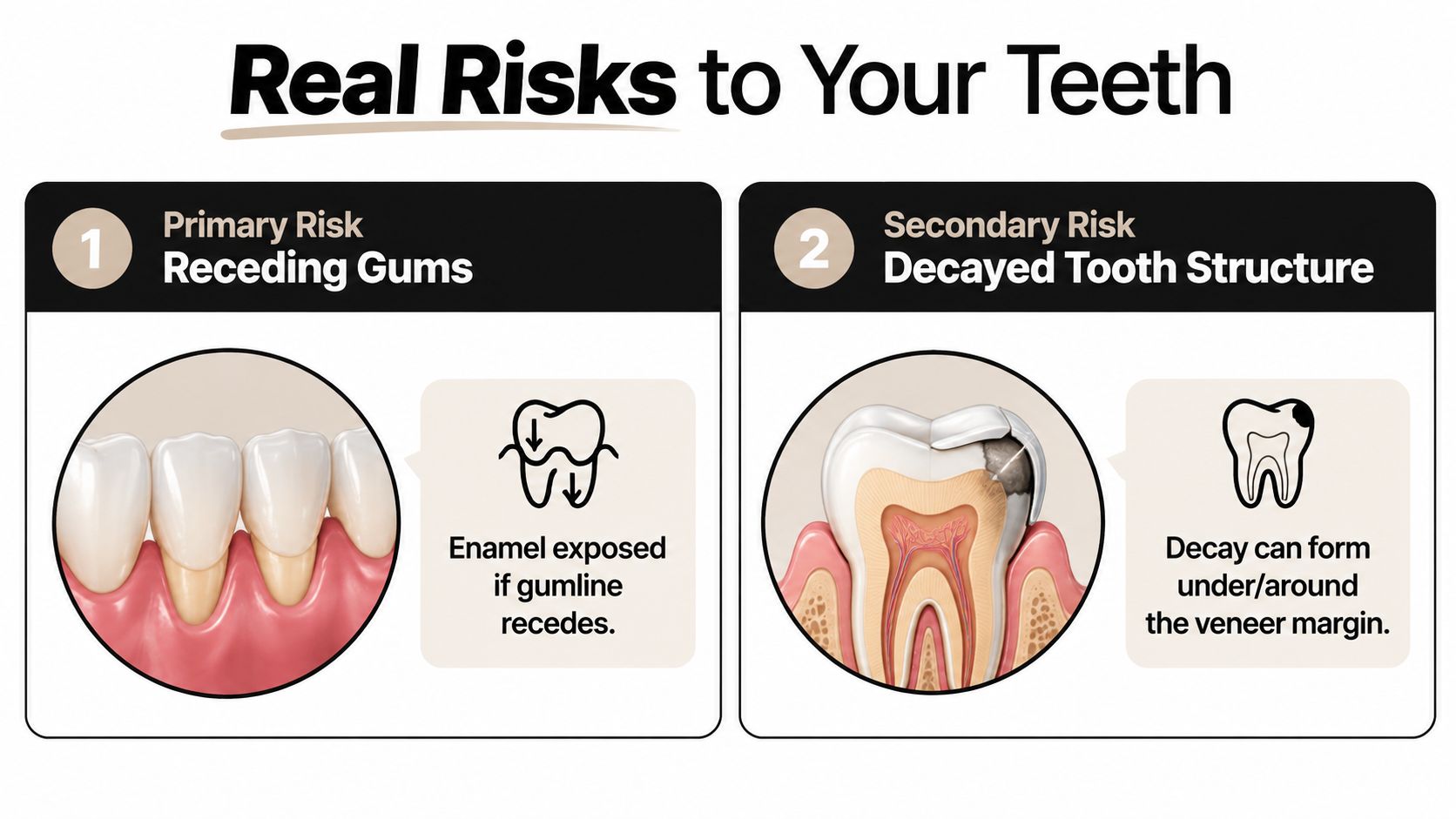 A diagram illustrating two primary dental risks: receding gums and decayed tooth structure caused by veneers.