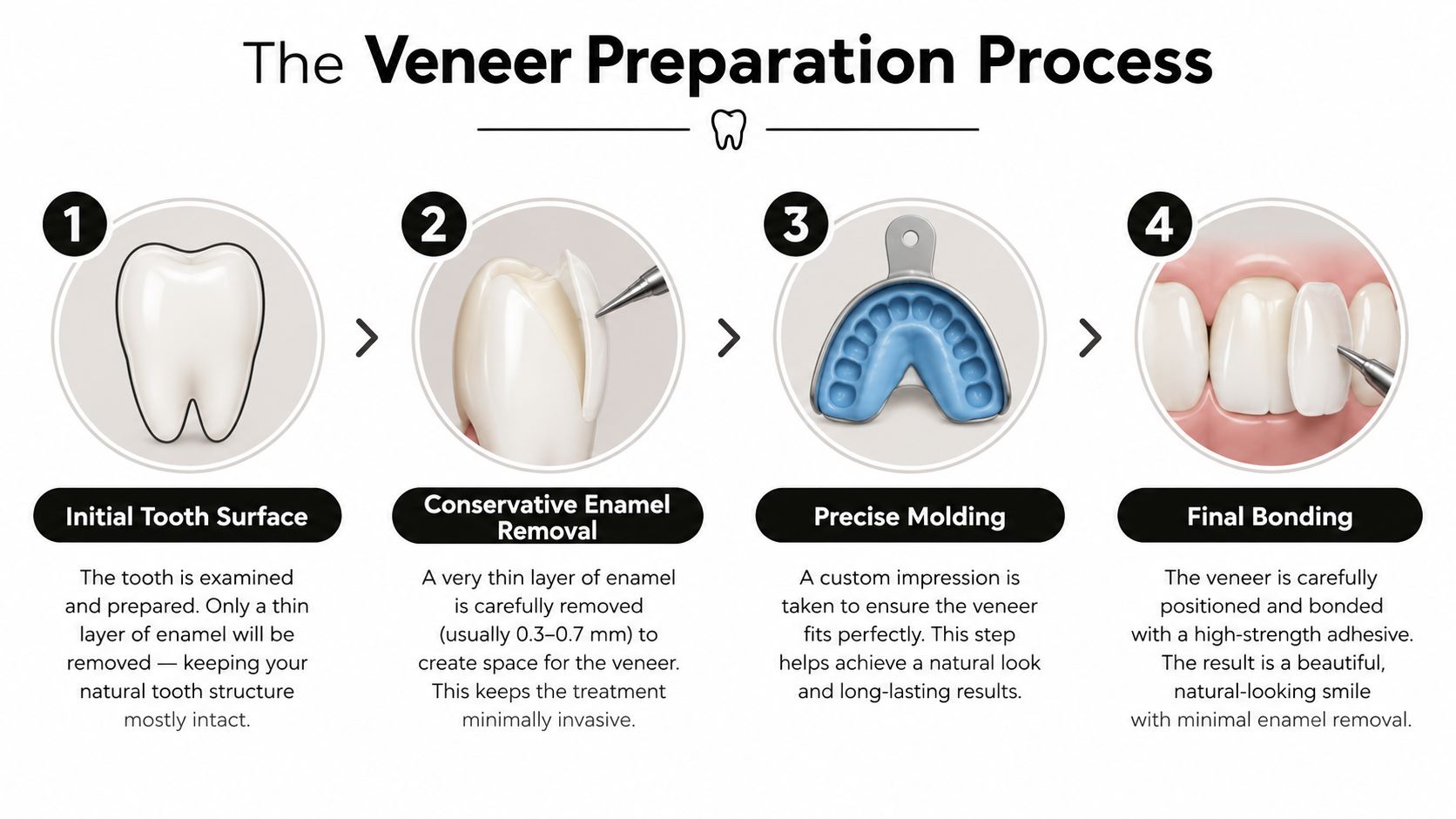 A step-by-step infographic illustrating the four stages of the dental veneer preparation process for cosmetic dentistry.
