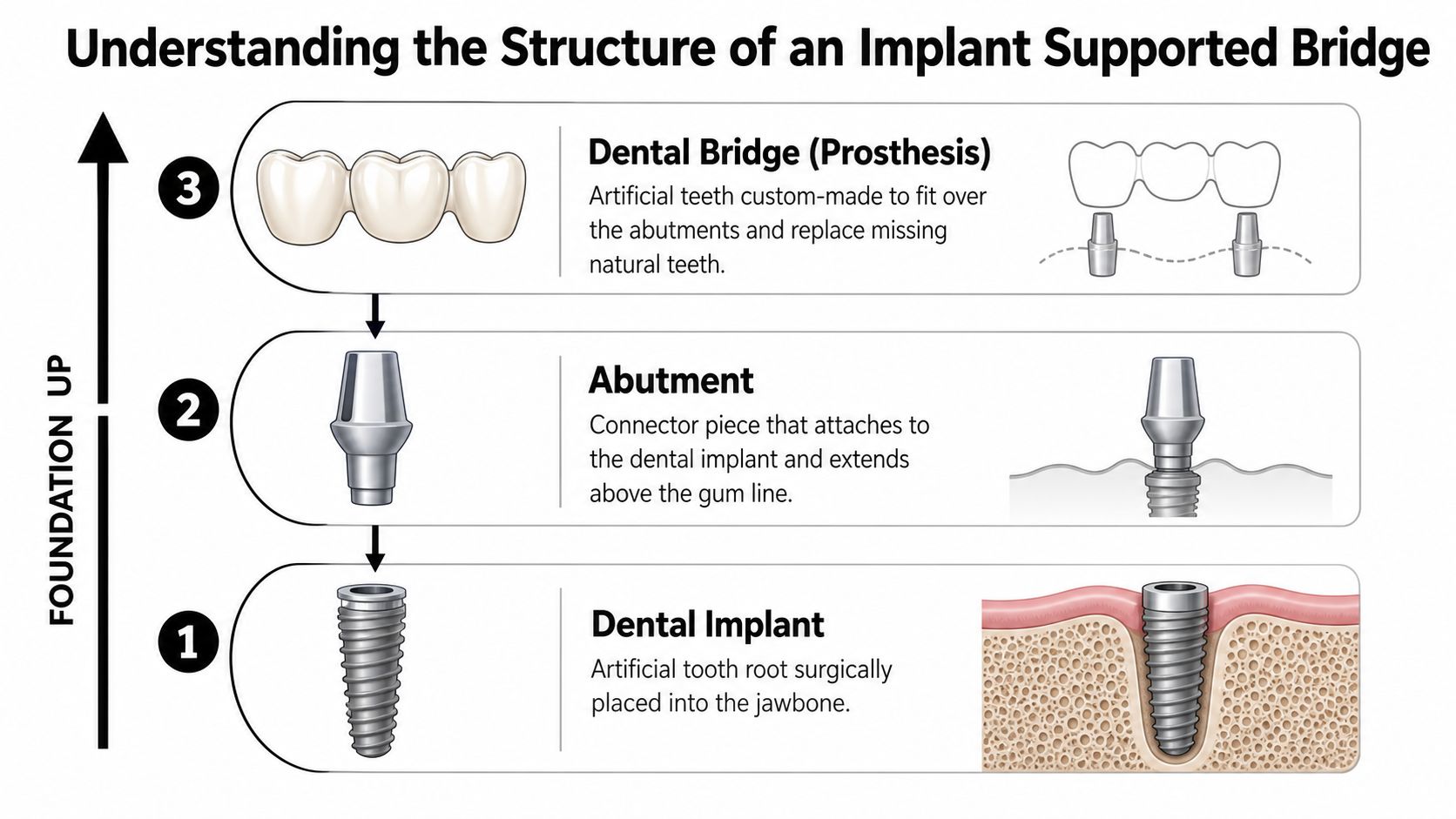 A diagram illustrating the three components of an implant supported bridge: dental implant, abutment, and prosthesis.