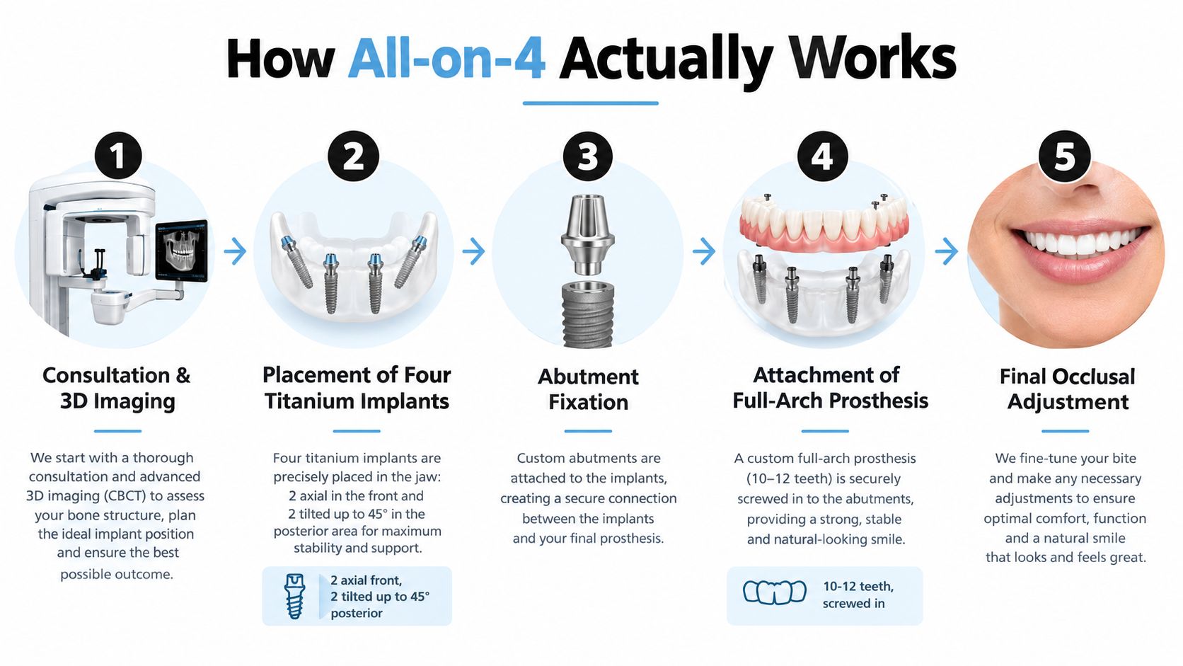 A five-step infographic showing the dental All-on-4 implant process from 3D imaging to the final smile.