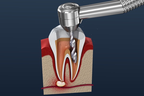 The Number Of Visits Needed For A Root Canal Treatment