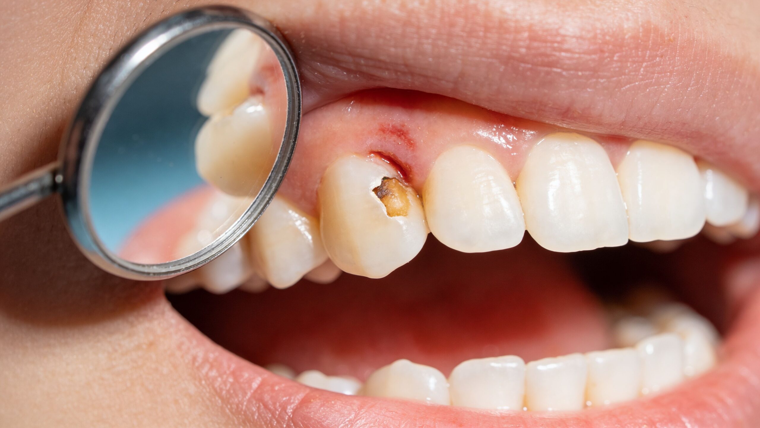 A close-up view of a dental cavity and inflamed gum being examined with a small dental mirror.