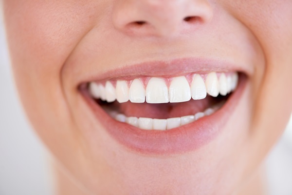 Professional Teeth Whitening After Orthodontic Treatment