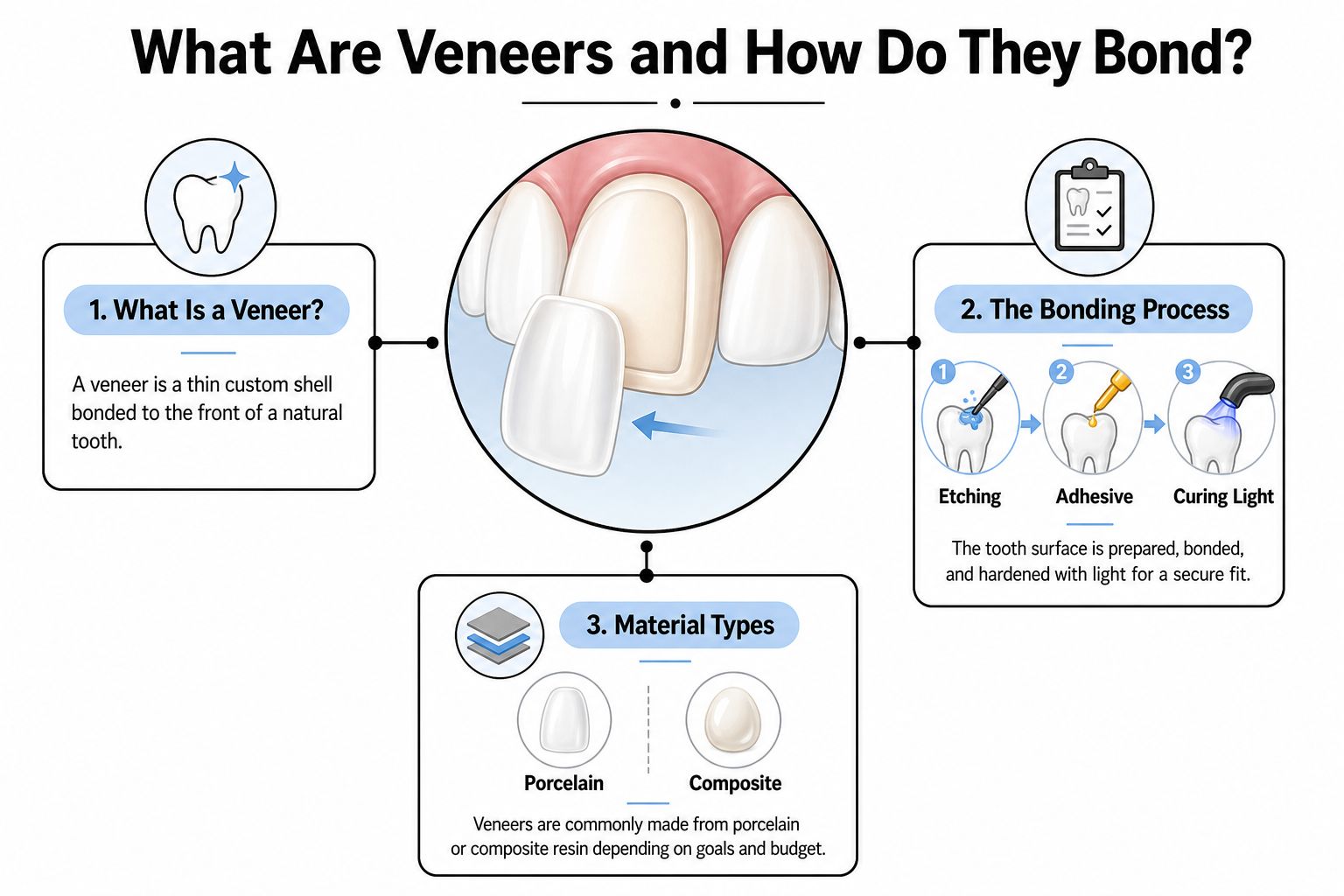 An infographic illustrating the dental veneer process, covering the definition, the bonding steps, and common material types.