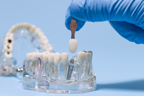 Ways An Implant Dentist Will Help You Take Care Of Your Smile