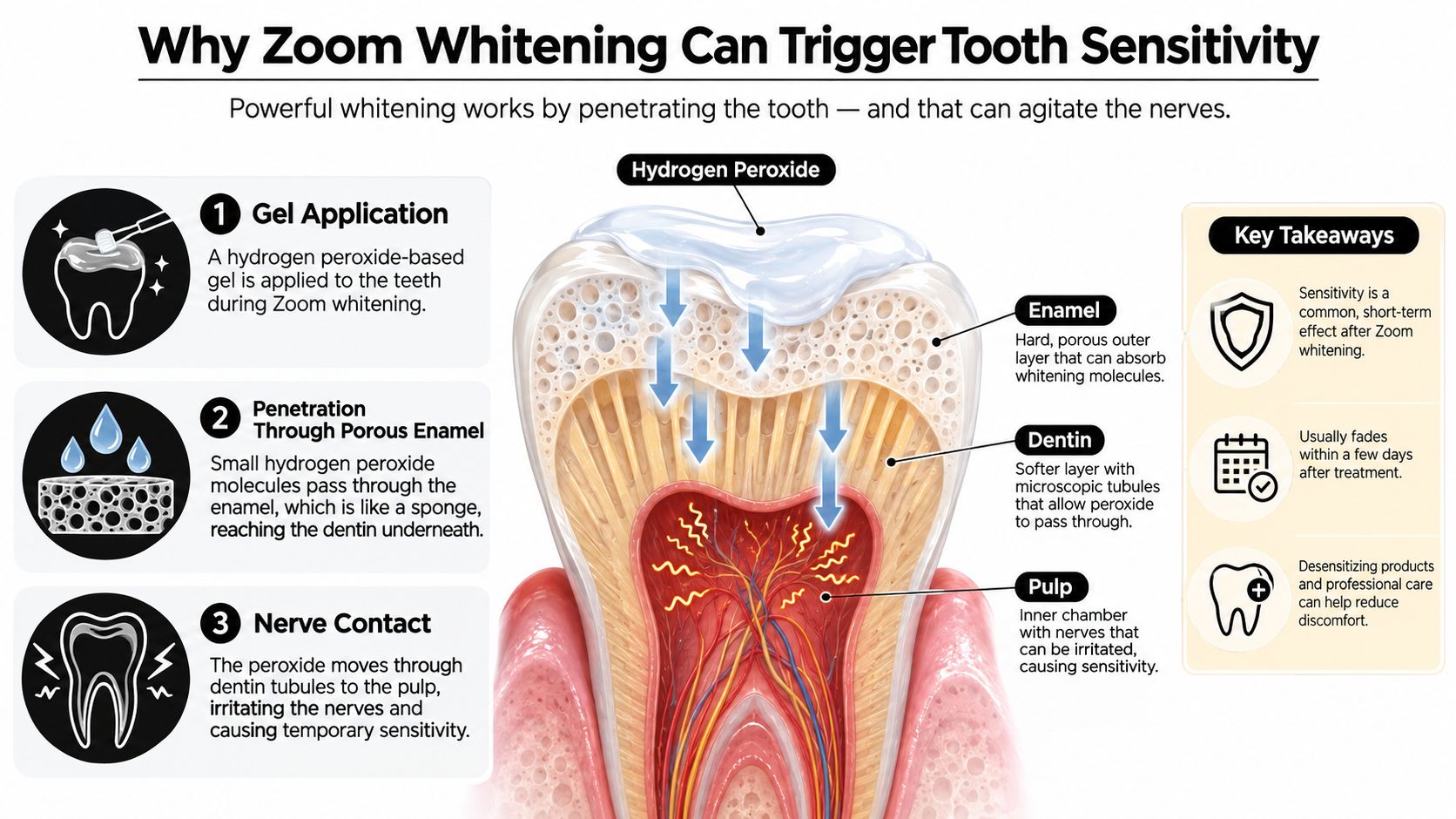 A diagram explaining how Zoom teeth whitening gel penetrates enamel and dentin to reach nerves causing sensitivity.